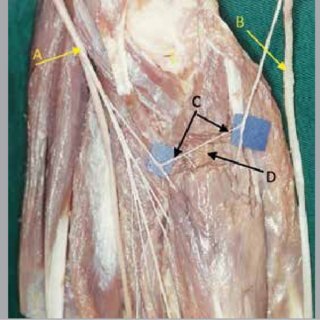 A) Median nerve; (B) Ulnar nerve; (C) Intramuscular Martin-Gruber