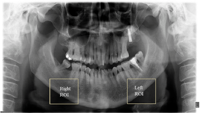 A Digital Dental Panoramic Radiograph Of A 61 Year Old Female With