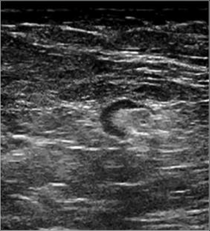 B Ultrasound Image Of The Same Patients Left Axillary Region At Level