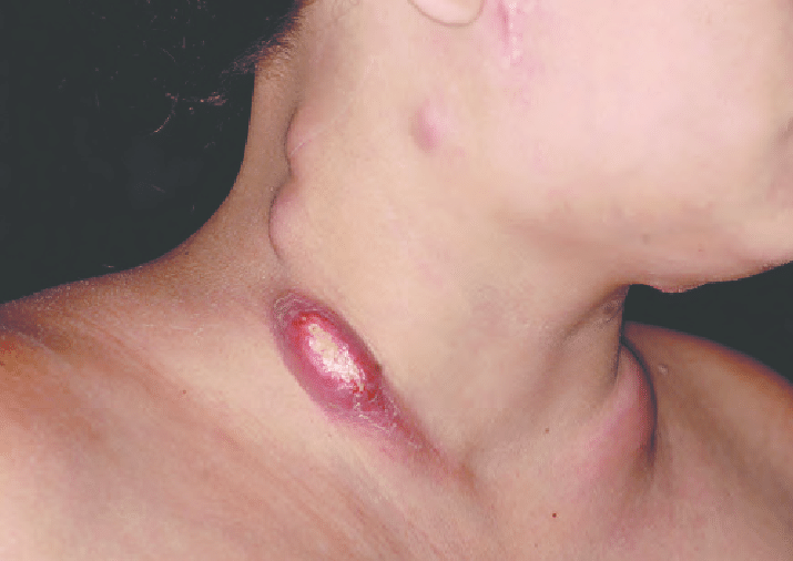 Paracoccidioidomycosis Swollen Lymph Nodes With Inflammatory Aspect