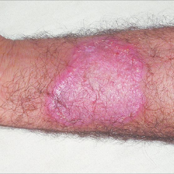 (PDF) Annular atrophic plaque over the arm