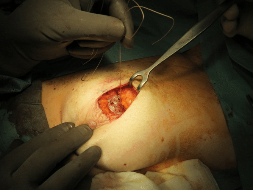 3-D marker placed in lumpectomy cavity and sutured to glandular