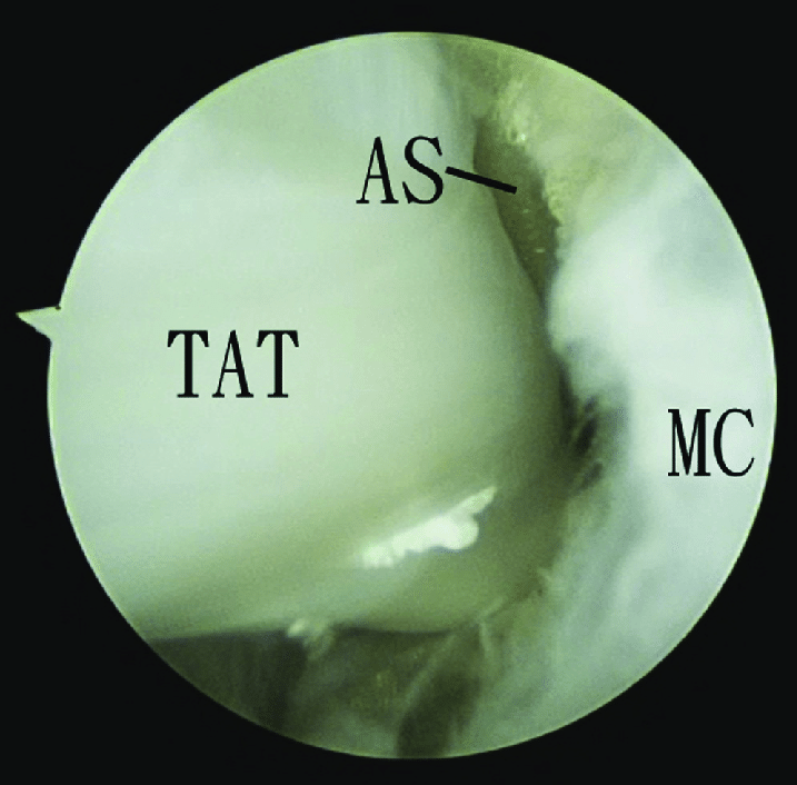 Endoscopic Resection Of The Tibialis Anterior Tendon Tat Bursa Of The