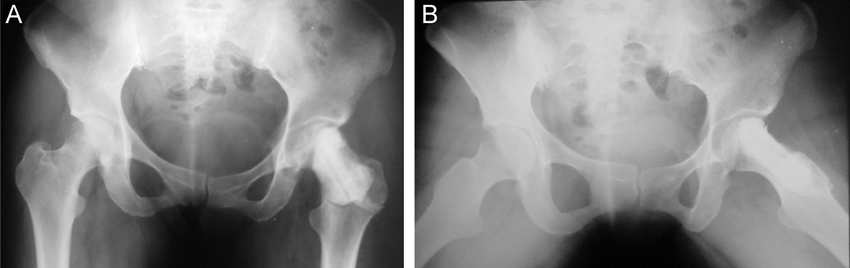 Hip Radiograph In Anteroposterior A And Lowenstein Lateral B