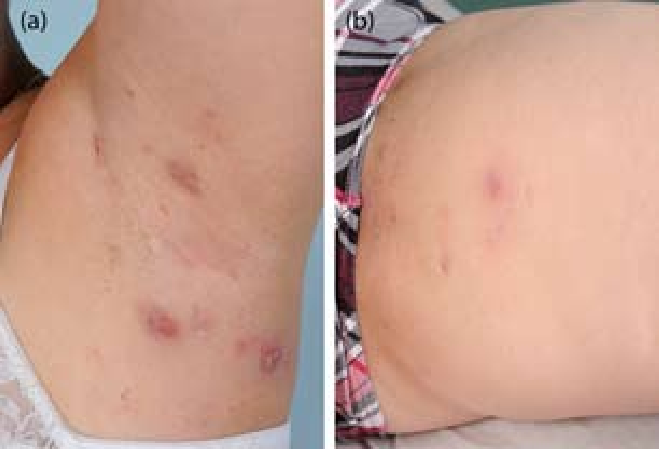 Nodules, folliculitis, cysts and depressed scars in the classic