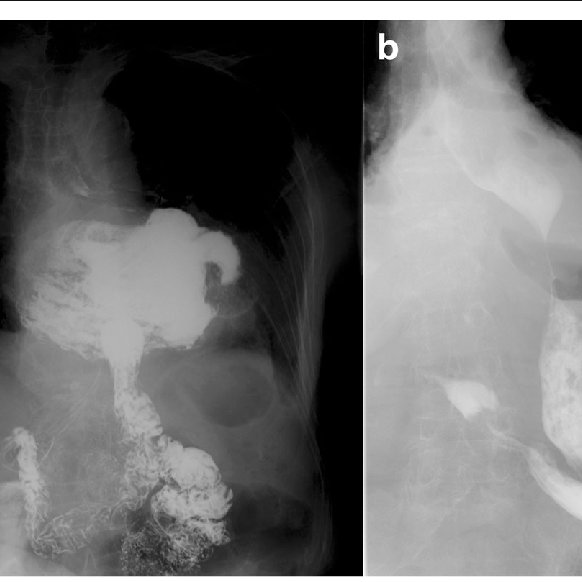 The Type Iiiiv Hiatal Hernia Before And After Surgery Upper
