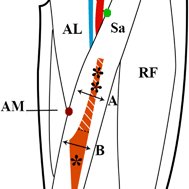 Plane of separation between VMO and VML -nerve (red arrow) VMO-vastus ...