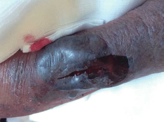 Bullous hemorrhagic lesions. (A) Tense, hemorrhagic bulla on the