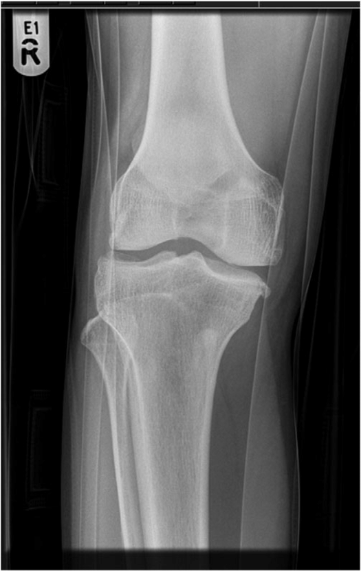 Lateral Radiograph Of Knee Showing Dislocated Patella Figure 2 Ap