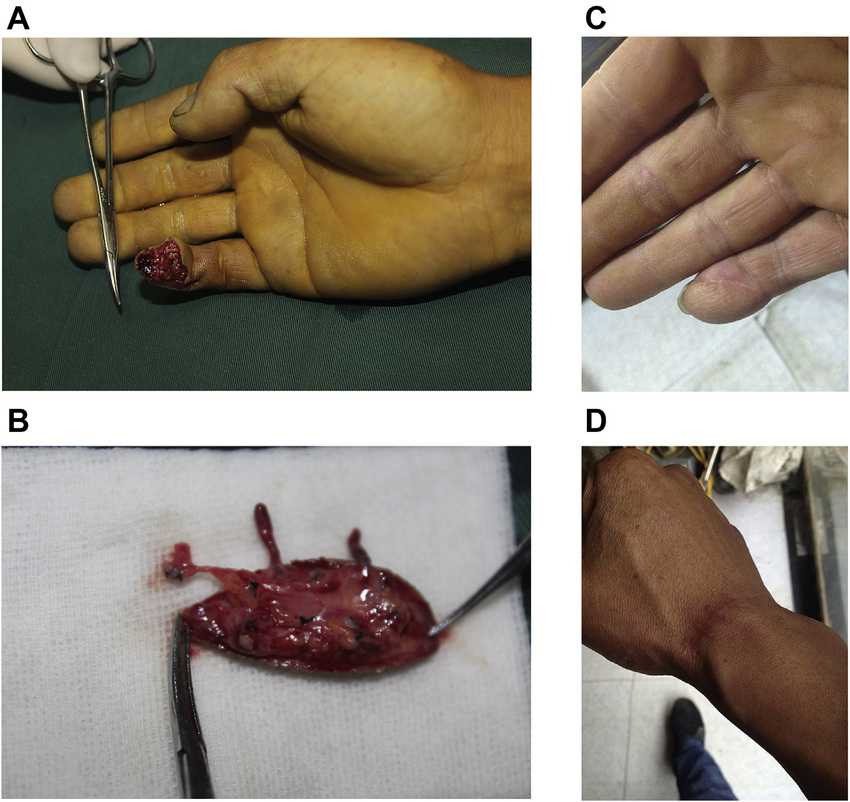 A: The 25-year-old patient had a severe crush injury to his right lower