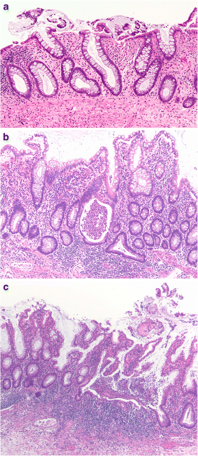 A Chronic Inactive Ulcerative Colitis The Biopsy Shows Crypt