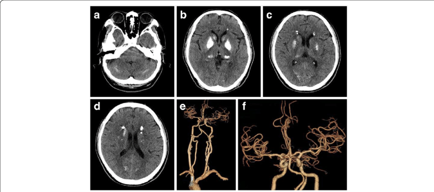 Computed Tomography Ct And Ct Angiography Cta A D Symmetric