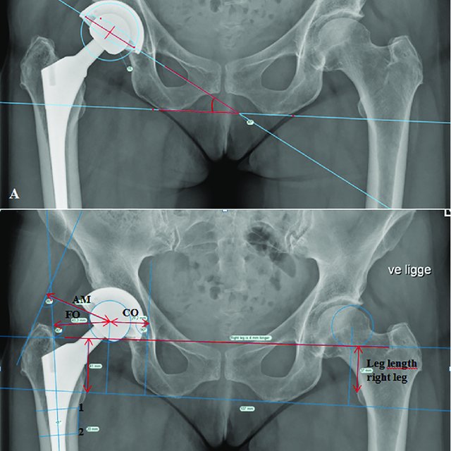 (PDF) Radiographic cup position following posterior and lateral ...