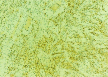 At immunohistochemistry, tumor cells stain strongly for PS100, × 400 ...