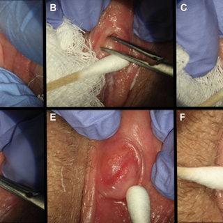 Surgical Techniques: Dorsal Slit Surgery for Clitoral Phimosis