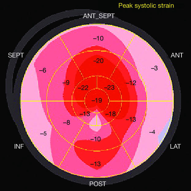 Longitudinal echocardiography strain depicted in bull's-eye map showing
