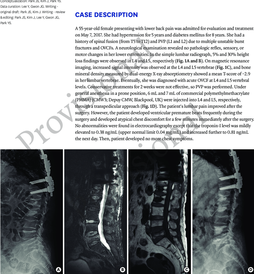 The diagnosis and treatment of acute osteoporotic vertebral compression