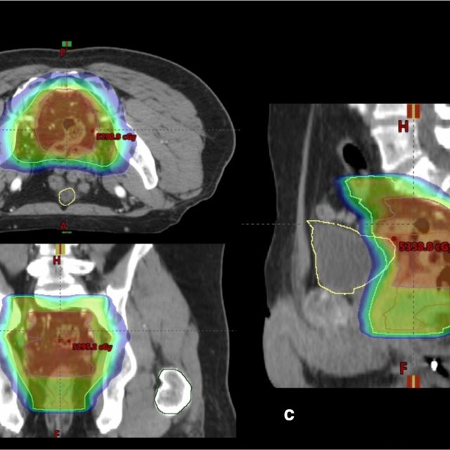 Intensity Modulated Radiotherapy Imrt Plan For Patient With T3n2