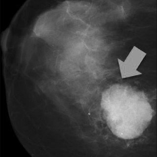 Mammogram of a 46-year-old woman with a palpable, high-density, oval