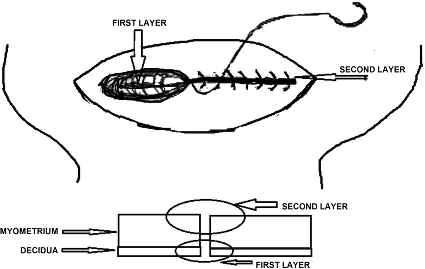 Illustration of double layer uterine closure technique