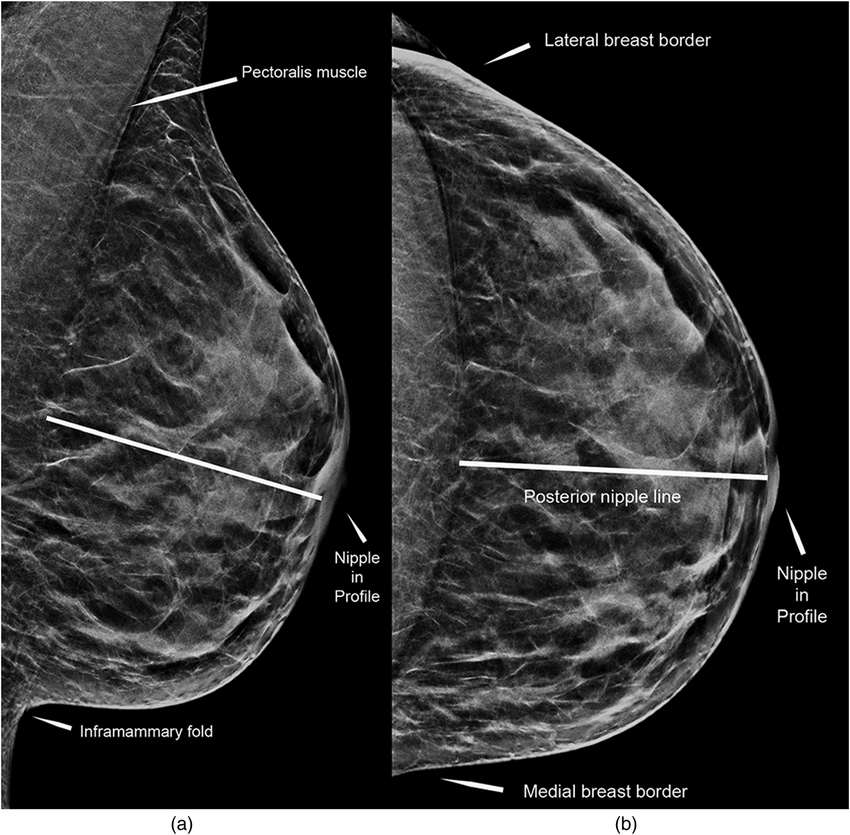 Illustration Of Positioning Criteria Of The Breast A Left Mlo View