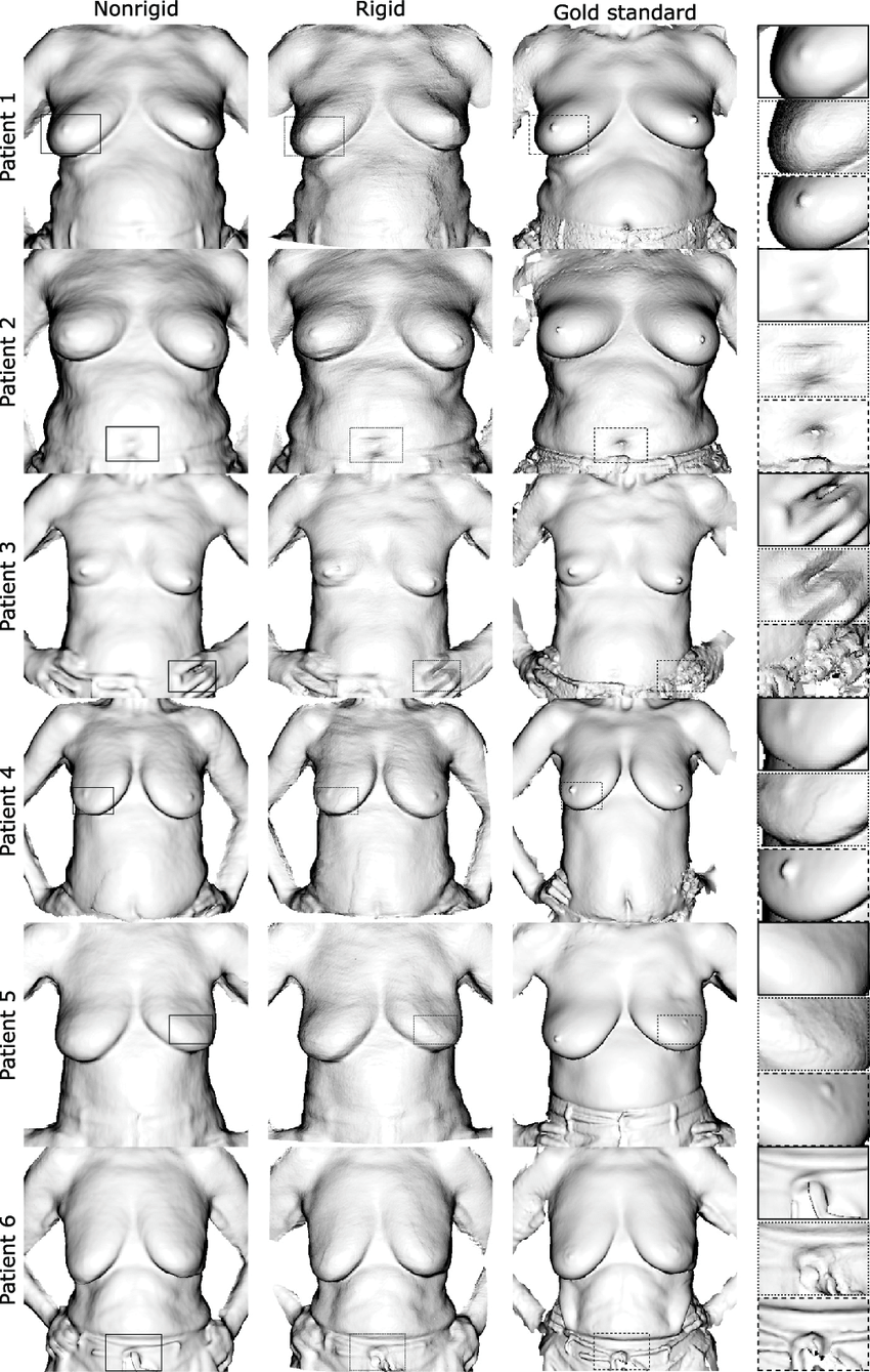 Qualitative results figure comparing Phong-shaded breast surface models