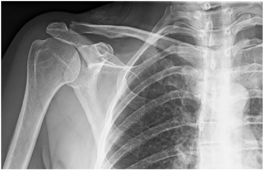 Anteroposterior Ap Radiograph Shows An Essentially Normal Appearance