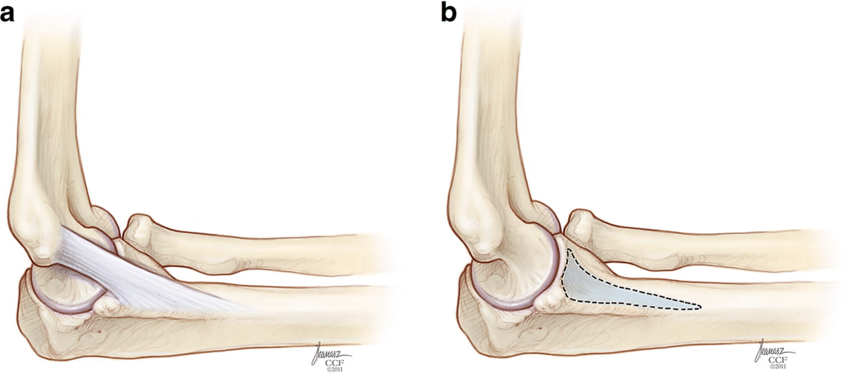 a, b Extended distal attachment of the anterior bundle of the medial ...