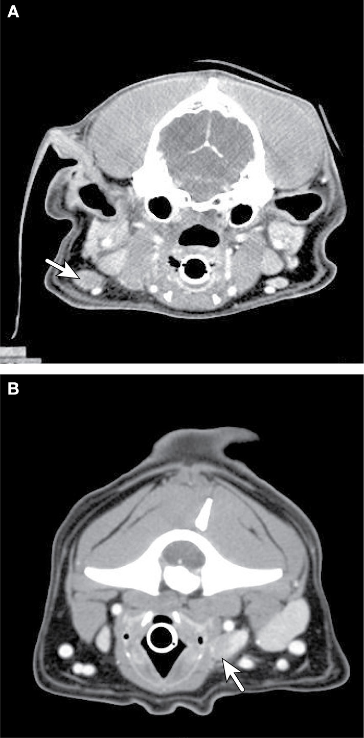 Axial Ct Imaging Of Metastatic Neck Lymph Nodes Associated With
