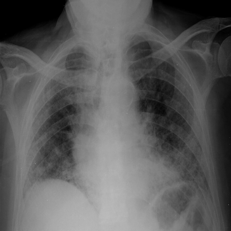 Chest radiograph showing a bilateral reticular pattern predominantly ...