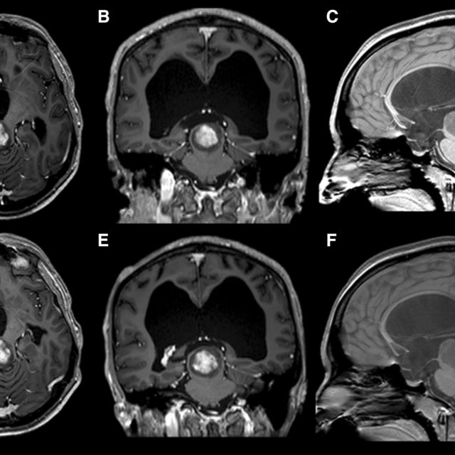 A B Axial And Coronal T1 Post Gadolinium Mri Images 8 Weeks After