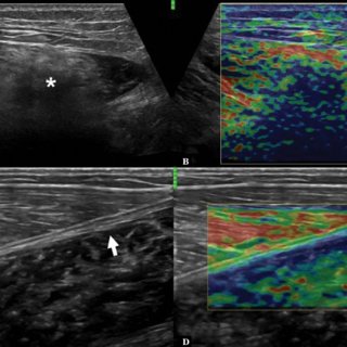 Muscle hernia in a 40-year-old man with a tender palpable mass at