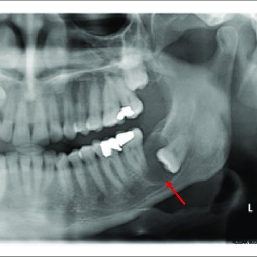 Bilateral Mandibular Cyst Lateral Radicular Cyst Paradental Cyst Or ...