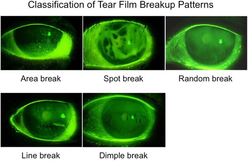 Classification of fluorescein breakup patterns. Download Scientific Diagram