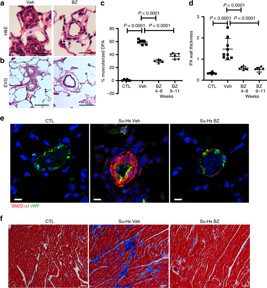 IL-32 in PAH. ( A – D ) Triple-label immunofluorescence images of
