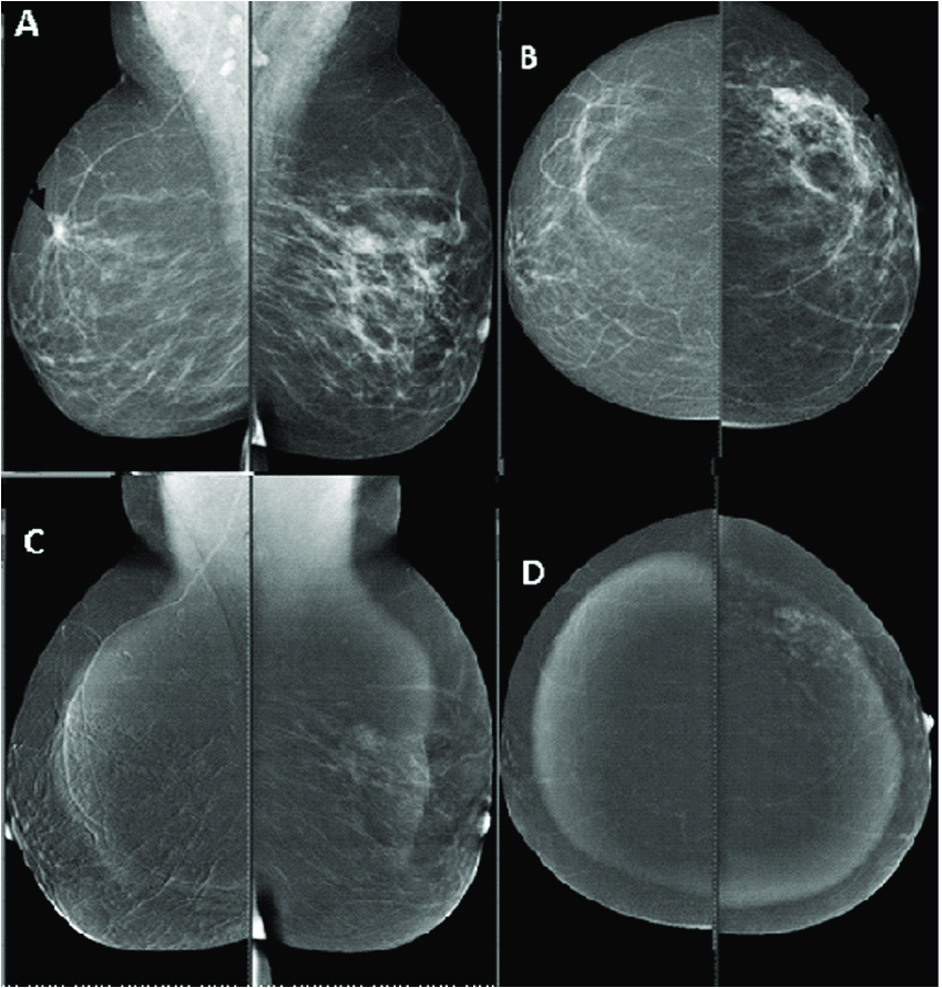 A) Bilateral medio-lateral mammograms revealed asymmetric breast