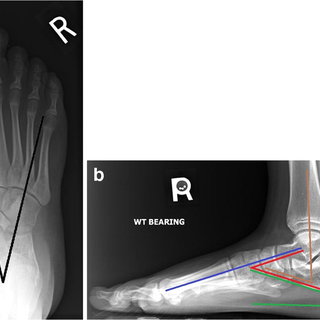 Cole osteotomy in a 10-year-old boy with Charcot–Marie–Tooth disease ...