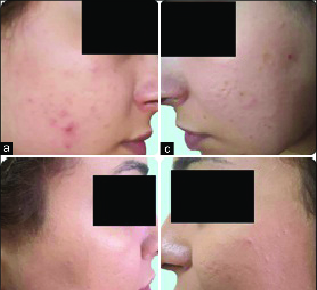 faces with acne vulgaris