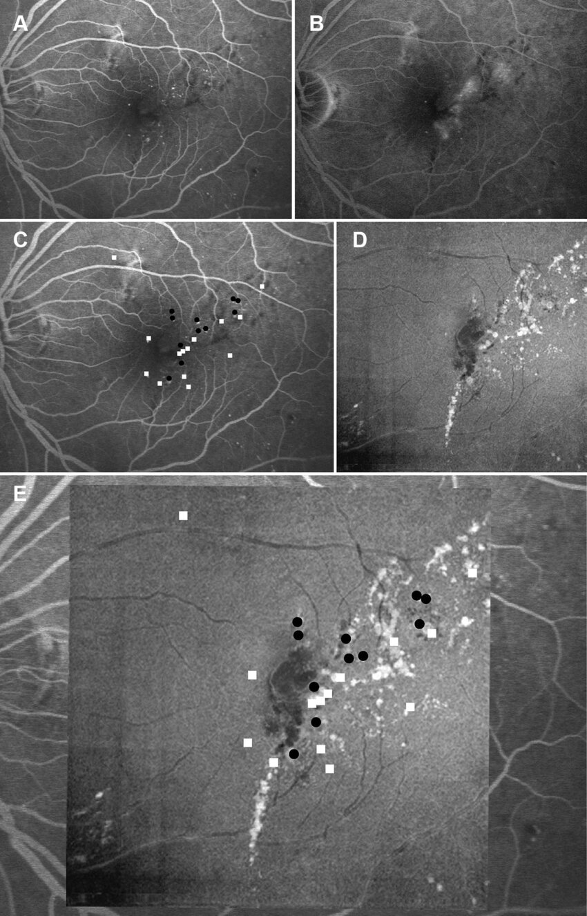 Analysis of en face and fluorescein angiography images in visualization ...