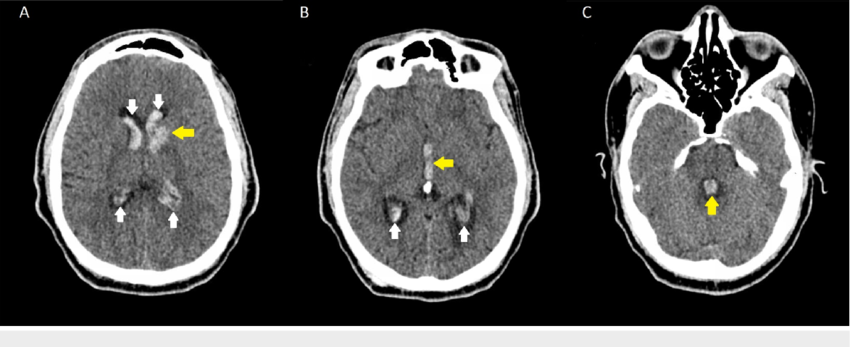 Intraparenchymal hemorrhage with intraventricular extension CT of the ...