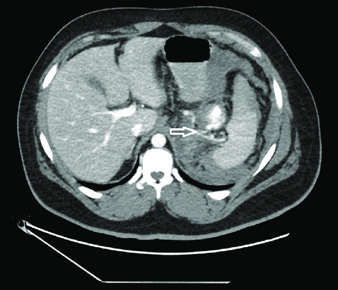Abdominal Ct Scan With Iv Contrast Showing A Thin Neck Connecting The