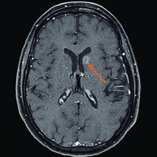 IRM cérébrale (séquence T1 transverse après injection de ...