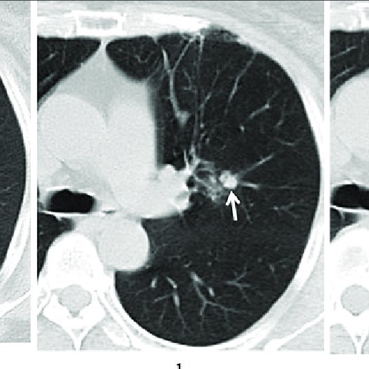 Computed Tomography Of The Affected Lung A A Lobulated Mass Arrow