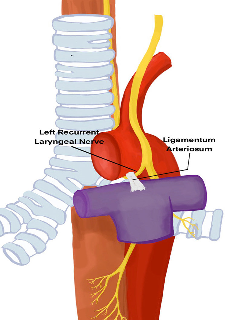 left recurrent laryngeal nerve ligamentum arteriosum