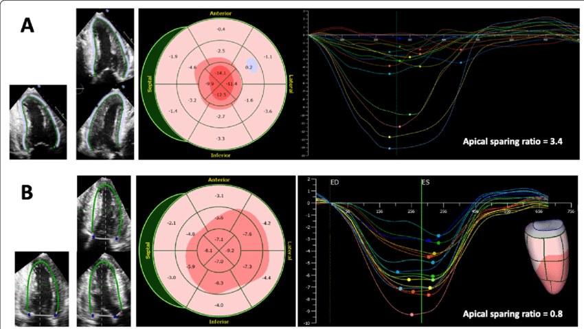 Echocardiographic Assessment of Myocardial Deformation during