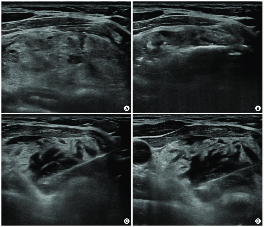 A Ultrasonography Showing A Benign Thyroid Nodule 17×38×45 Cm In