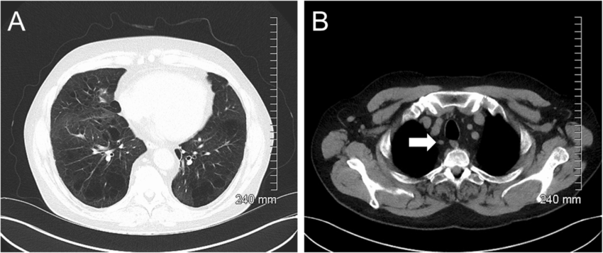 Initial Ct Thorax Demonstrated No Acute Pulmonary Infiltrates Or
