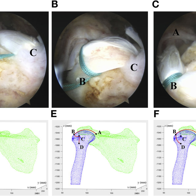 Intraoperative view and simulation of LHBT rerouting of right shoulder ...