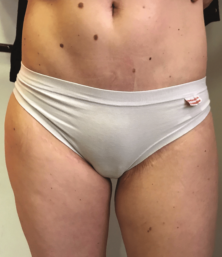 two-year postoperative view of the patient (wearing underwear