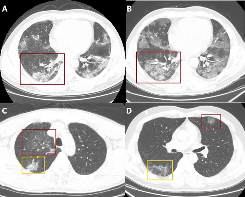 Typical CT manifestations 2. A and B. An initial CT scan (A) compared ...